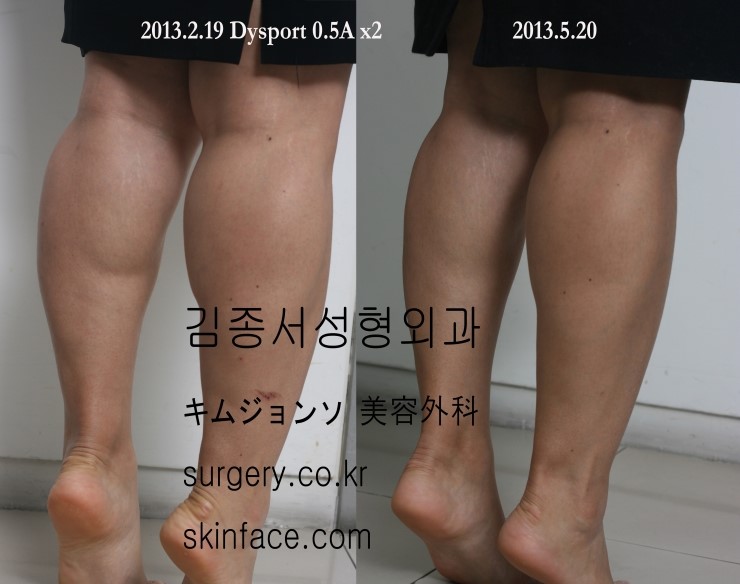 바디톡신 이란? 바디톡신을 알아보자~/ 순수톡신 제오민 / 강력한톡신 디스포트 /김종서성형외과 / 종아리보톡스/ 장딴지보복스/ 승모금보톡스 관련 이미지 2