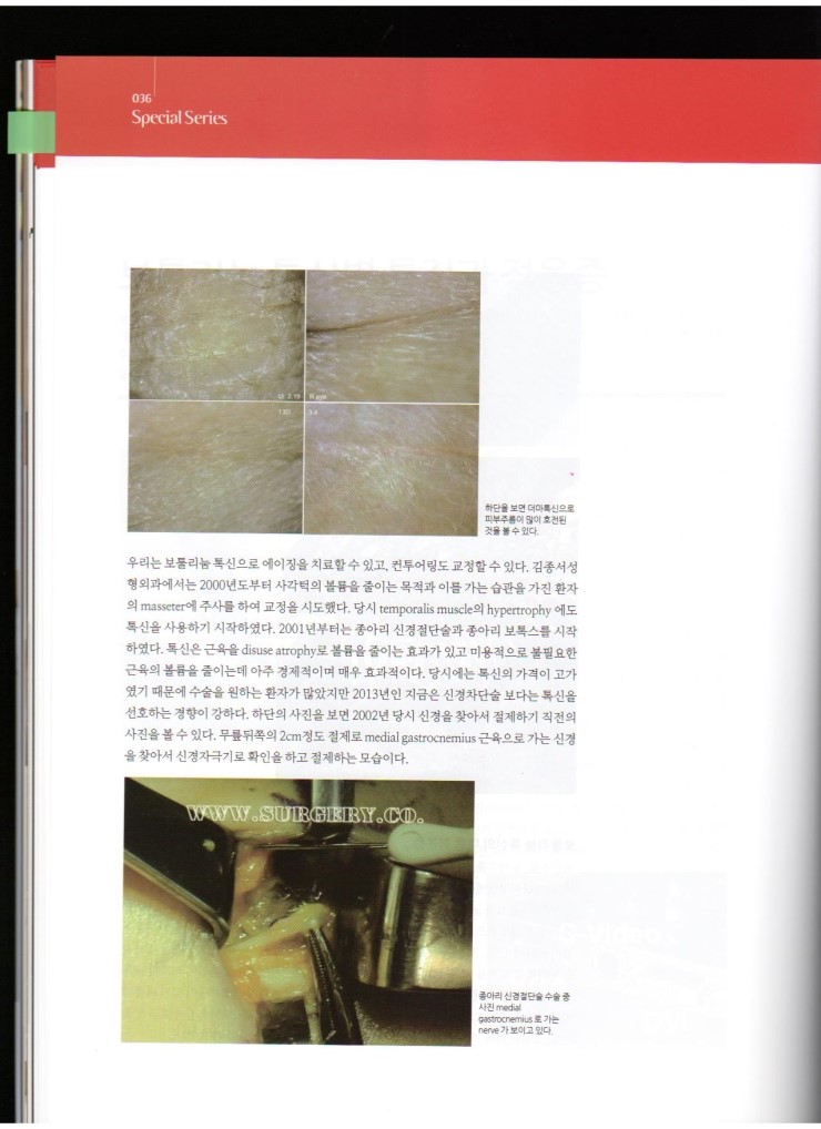 2013년 11월호 Medical에 김종서 원장님 "보툴리눔 톡신별 특징과 적응증"에 대한 기사가 실렸습니다. 관련 이미지 4