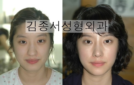 코성형 정보 확인! 관련 이미지 1