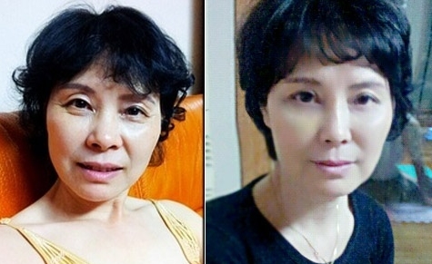 강남성형외과 안면거상술 관련 이미지 1