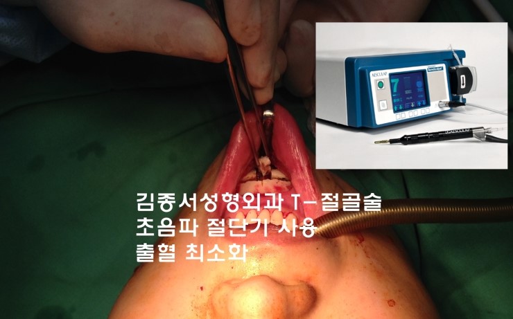 T절골 V라인사각턱 / 김종서성형외과 / 출혈을 최소화 멍들지 않게 관련 이미지 1