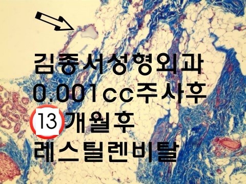 홍콩 레스틸렌 비탈 물광주사 개발 강의 후 한국 레티나지 소개 관련 이미지 11