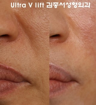 울트라 V리프트 스마트리프트 관련 이미지 2