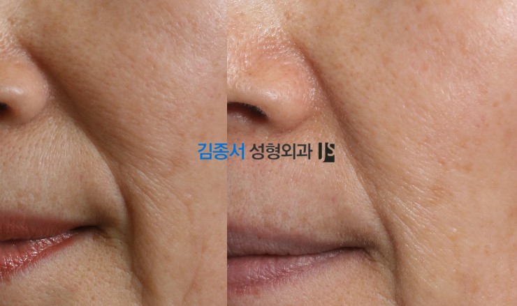 [물광주사] 물광주사 추천 / 오래가는물광주사 / 레스틸렌물광 / 효도성형 물광 / 김종서성형외과 관련 이미지 3