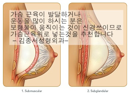 물방울가슴성형 여름준비하기 관련 이미지 4