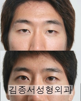 Amazing Facts About Eye Plastic Surgery image 13