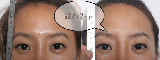 눈썹리프팅 울트라포머 / 김종서성형외과 관련 이미지 3