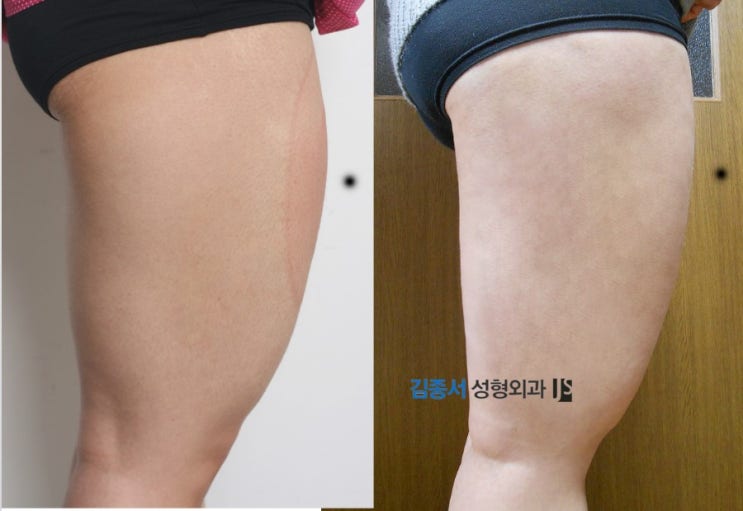 [클라투] 냉각지방분해술 / 지방분해 효과 / 클라투 효과 / 다이어트 / 김종서 성형외과 관련 이미지 1