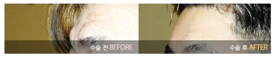 Gangnam Plastic Surgery Wrinkle Removal Surgery / Facelift image 3