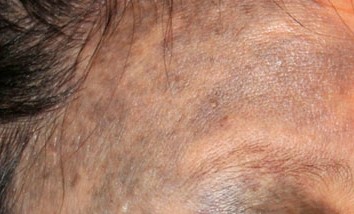 Sinsa-dong Plastic Surgery Clinic - Ota Nevus Treatment image 3