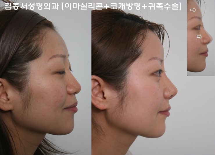 5분만의 간단한 주사요법으로 명품코만들기! 관련 이미지 7