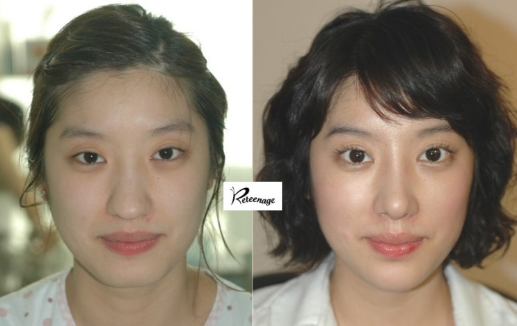 [무턱 필러] 고어텍스를 이용한 코끝과 무턱수술 (개방형코수술/주먹코 교정) 관련 이미지 1