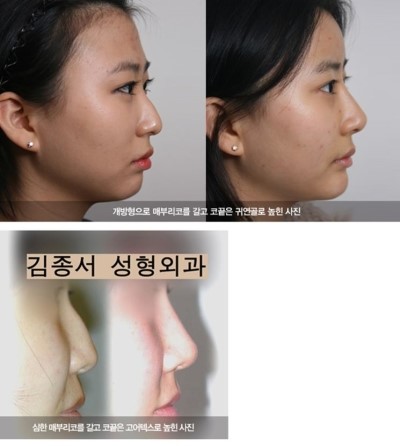 코성형, 개념정리 관련 이미지 8