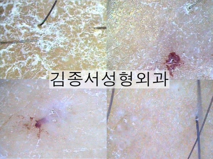 홍콩 레스틸렌 비탈 물광주사 개발 강의 후 한국 레티나지 소개 관련 이미지 16