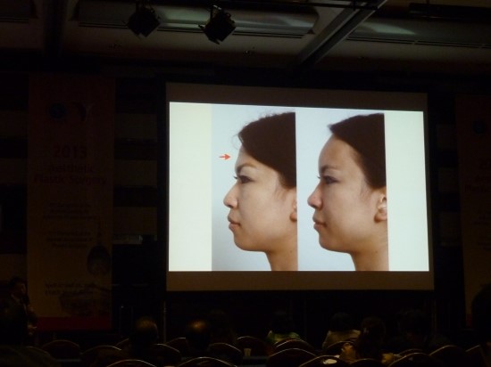 엄지원 필러/ 레스틸렌 비탈/ 물광주사/ 2013.4.28일 코엑스/ 대한미용성형외과학회 강연 / 김종서성형외과원장 관련 이미지 6
