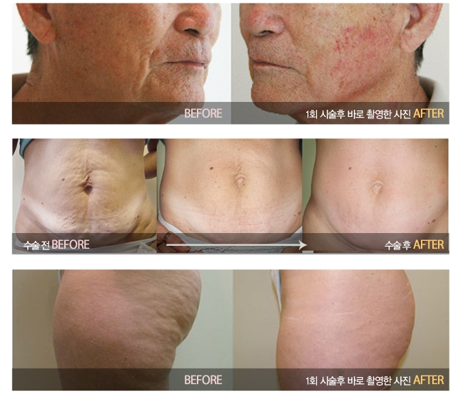 Shinsa-dong Plastic Surgery Clinic Radiofrequency Lifting for Wrinkle Removal, Bella Lifting image 2