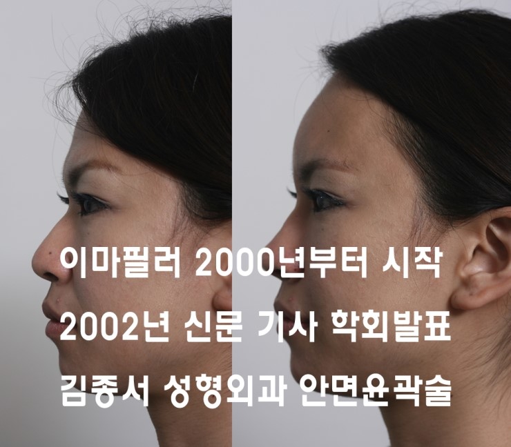 이마 성형 2002년부터 연구발표, 수많은 신문 기사에 ..김종서성형외과/ 봉긋한 이마 /동안이마 관련 이미지 7