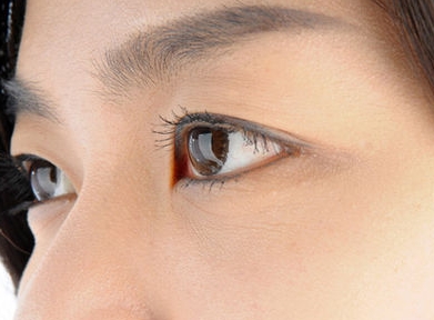 Under-Eye Ellansé image 1