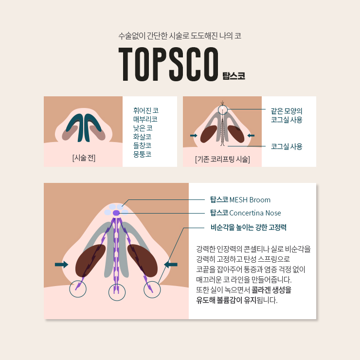 탑스코 ~간단한 시술로 콧대&middot;콧등&middot;콧대까지 한 번에!~ 관련 이미지 6