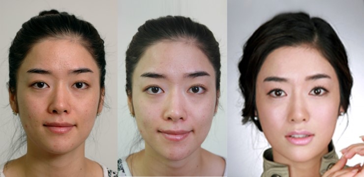 [울트라브이리프트] 김종서성형외과 관련 이미지 4