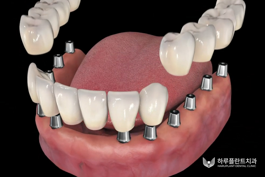 전체 임플란트 기간? 획기적으로 줄여드립니다 관련 이미지 4