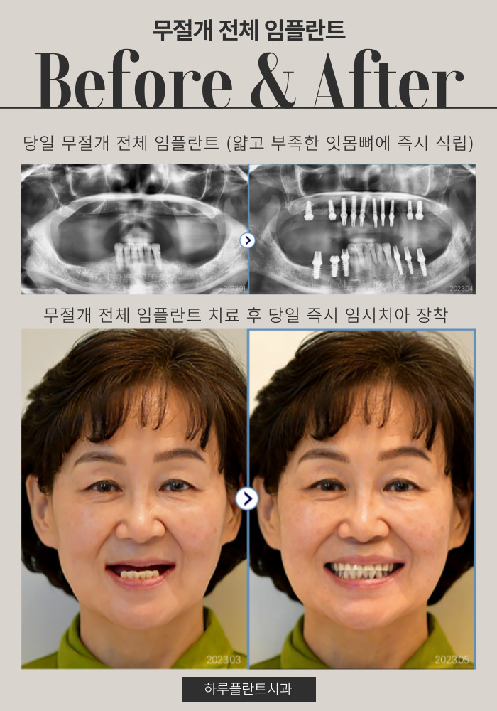 강남구전체임플란트 잘하는곳 이것만은 꼭 확인하세요 관련 이미지 5