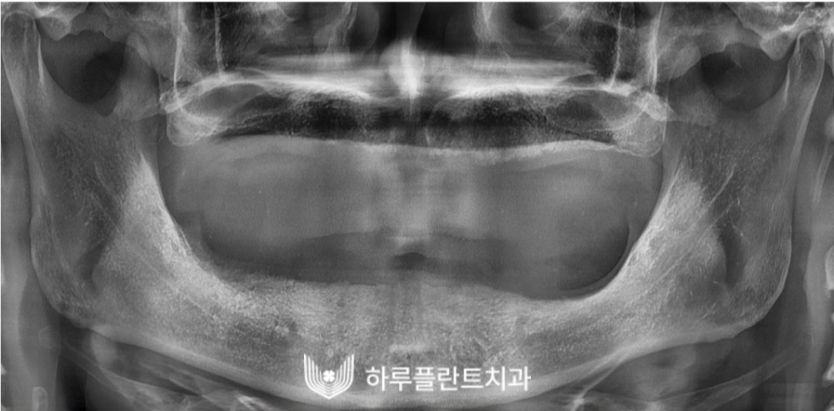 하루플란트치과 변성만 대표원장 타치과 임플란트 불가판정 성공사례 관련 이미지 6