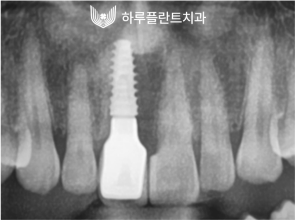 강남역 하루플란트치과 앞니 임플란트 후기 전후차이 관련 이미지 5