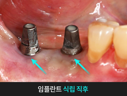 치과당일치료 하루플란트치과의 혁신적인 하루완성 클리닉 관련 이미지 3