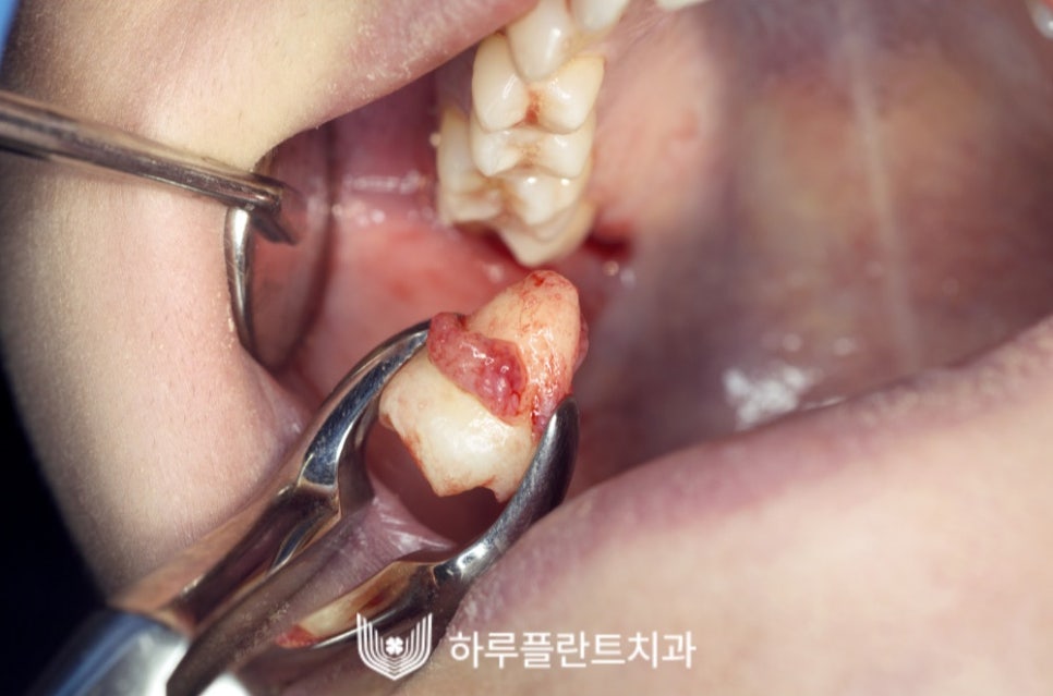 강남 하루플란트치과 사랑니발치, 사랑니 꼭 뽑아야할까요? 관련 이미지 2