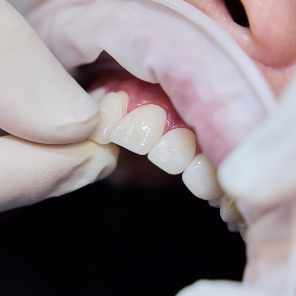 라미네이트, 수명이 걱정된다면? 하루플란트치과 하루네이트의 수명 체크 포인트 관련 이미지 4