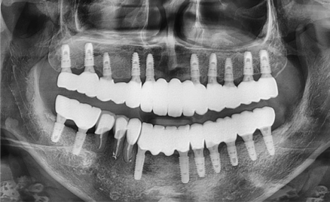 임플란트 뼈이식 수술 후기와 진행과정 공개 관련 이미지 11