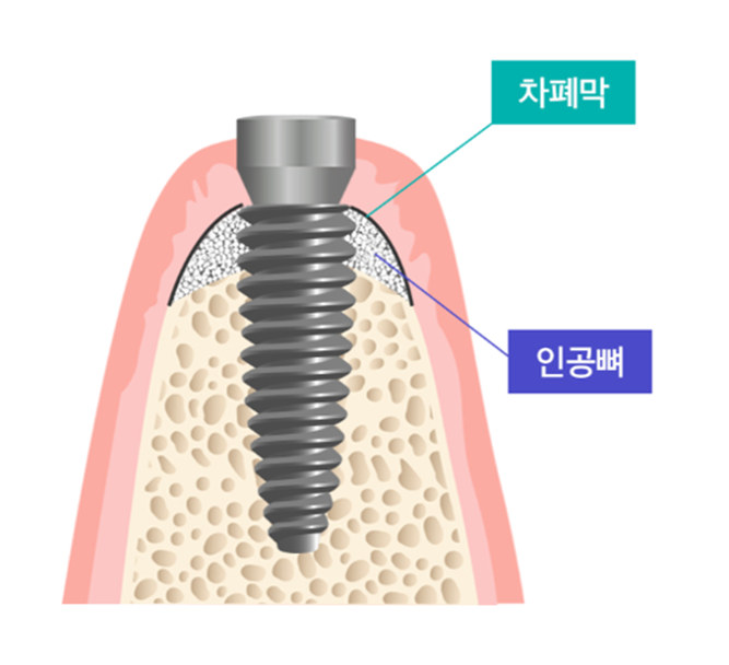 임플란트 뼈이식 수술 후기와 진행과정 공개 관련 이미지 2