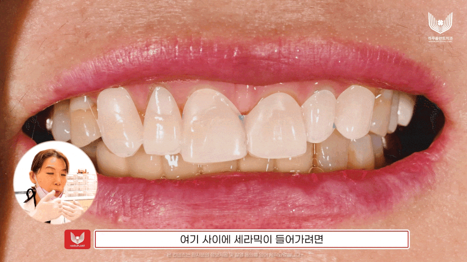 시니어 라미네이트, 이제는 인식이 바뀌어야 할 때 - 하루플란트치과 관련 이미지 6