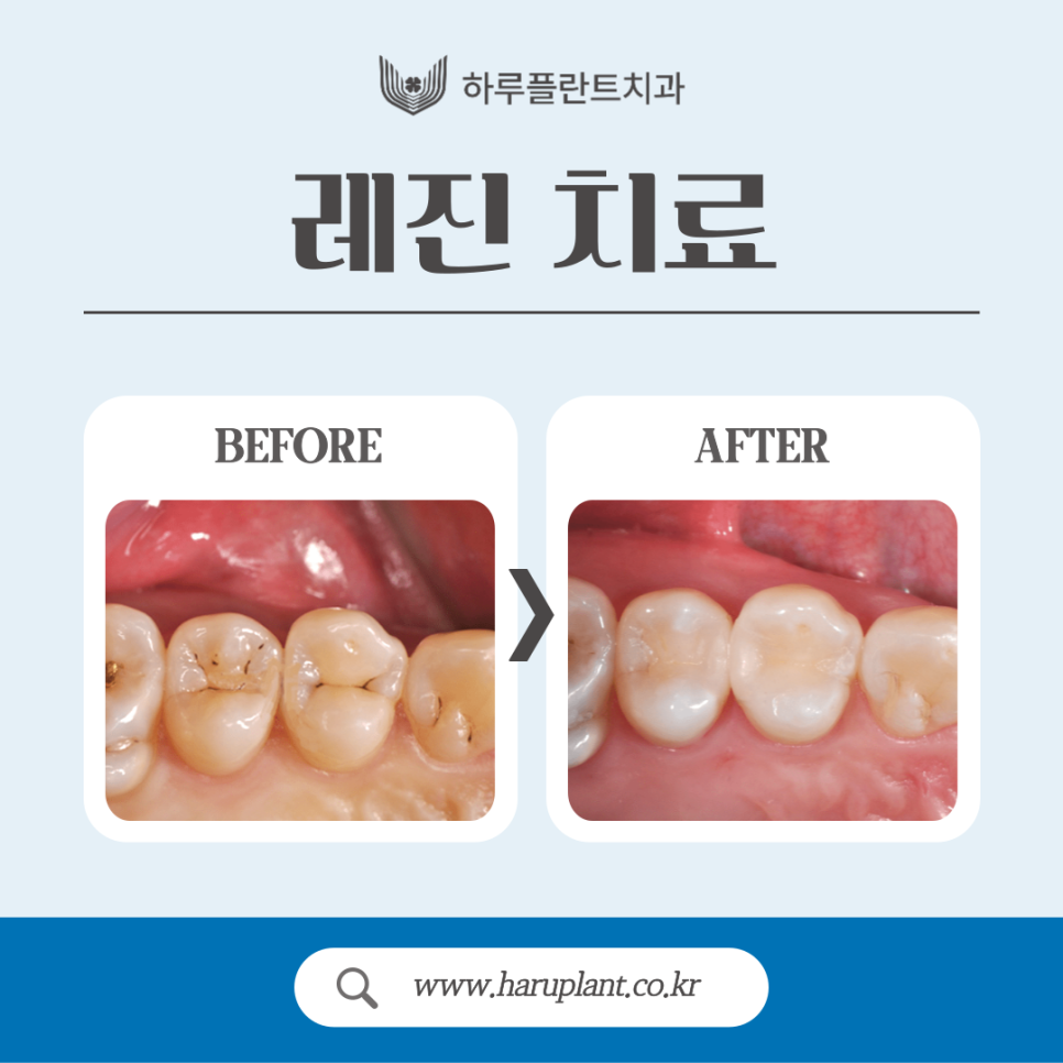 강남충치치료 레진 인레이 차이는? 관련 이미지 3