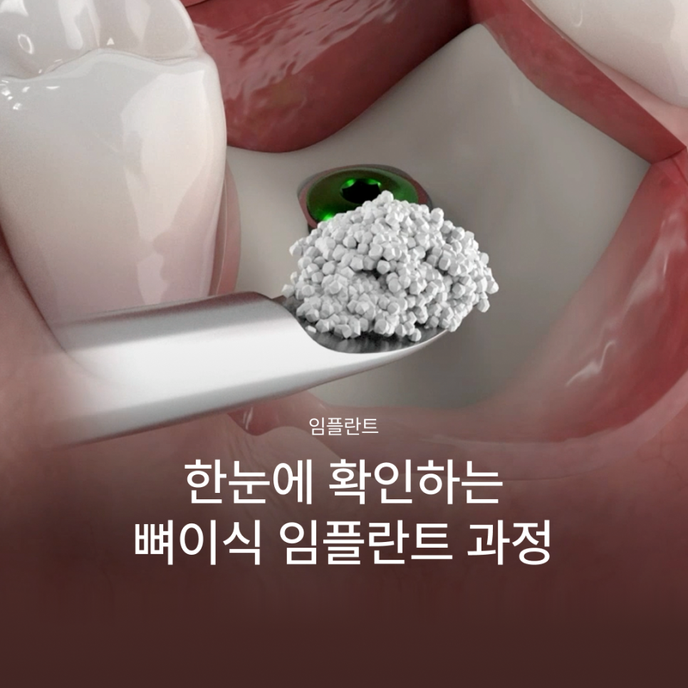 뼈이식임플란트 전 이런 점이 궁금하셨나요? 뼈이식임플란트과정과 기간, 통증까지 정리해드립니다 관련 이미지 1