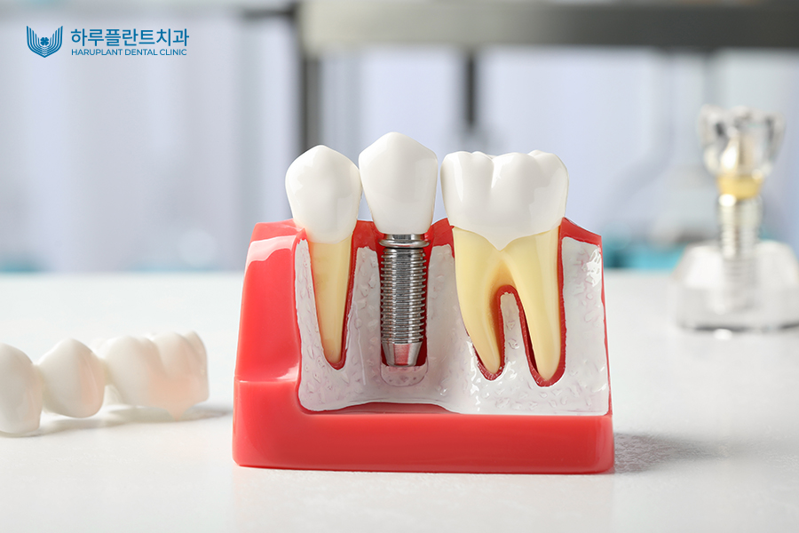 강남 원데이 임플란트, 하루만에 가능한 방법 알려드립니다 관련 이미지 4