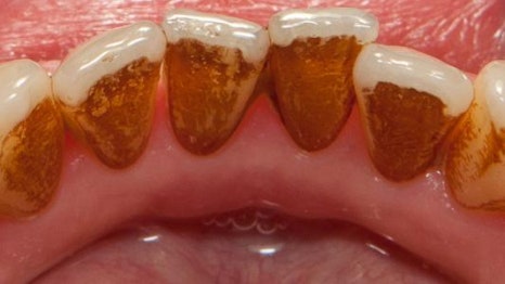 강남역스케일링 통증,시림 없는 프리미엄 에어플로우 스케일링 관련 이미지 9