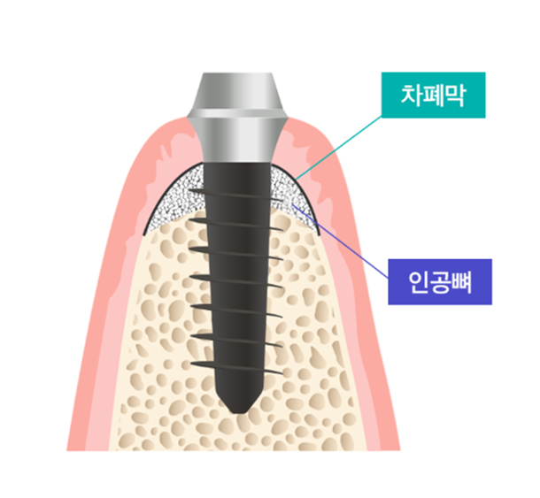 임플란트 뼈이식 수술 후기와 진행과정 공개 관련 이미지 6