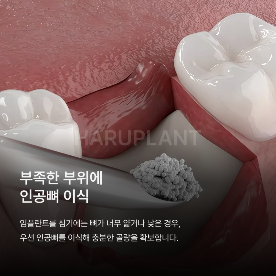 뼈이식임플란트 전 이런 점이 궁금하셨나요? 뼈이식임플란트과정과 기간, 통증까지 정리해드립니다 관련 이미지 5