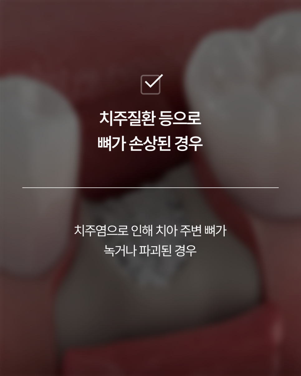 임플란트뼈이식, 반드시 필요할까요? 강남임플란트 하루플란트에서 기준을 확인하세요 관련 이미지 6