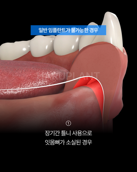 Why All-on-X Implants May Be Worth Considering Even If You Have Been Told That Full-Arch Implants Are Difficult image 3