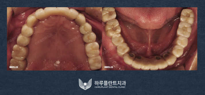 강남역치과 무치악 임플란트 알아보고 있다면 관련 이미지 6