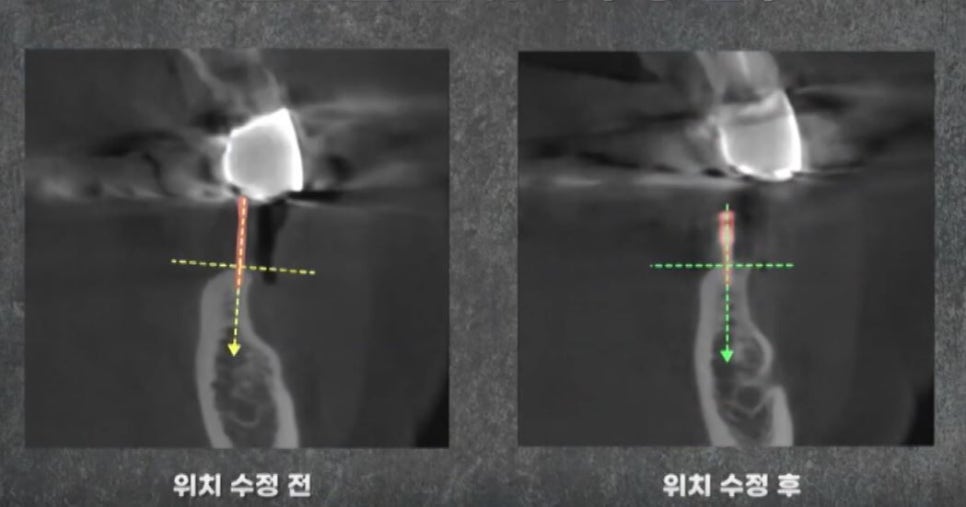임플란트 전문가 변성만 원장 TV 출연 - 통증 줄인 무절개 임플란트 관련 이미지 9