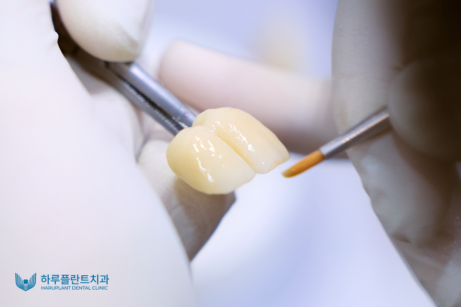 하루 만에 완성하는 자연스러운 심미치료, 하루네이트 관련 이미지 5