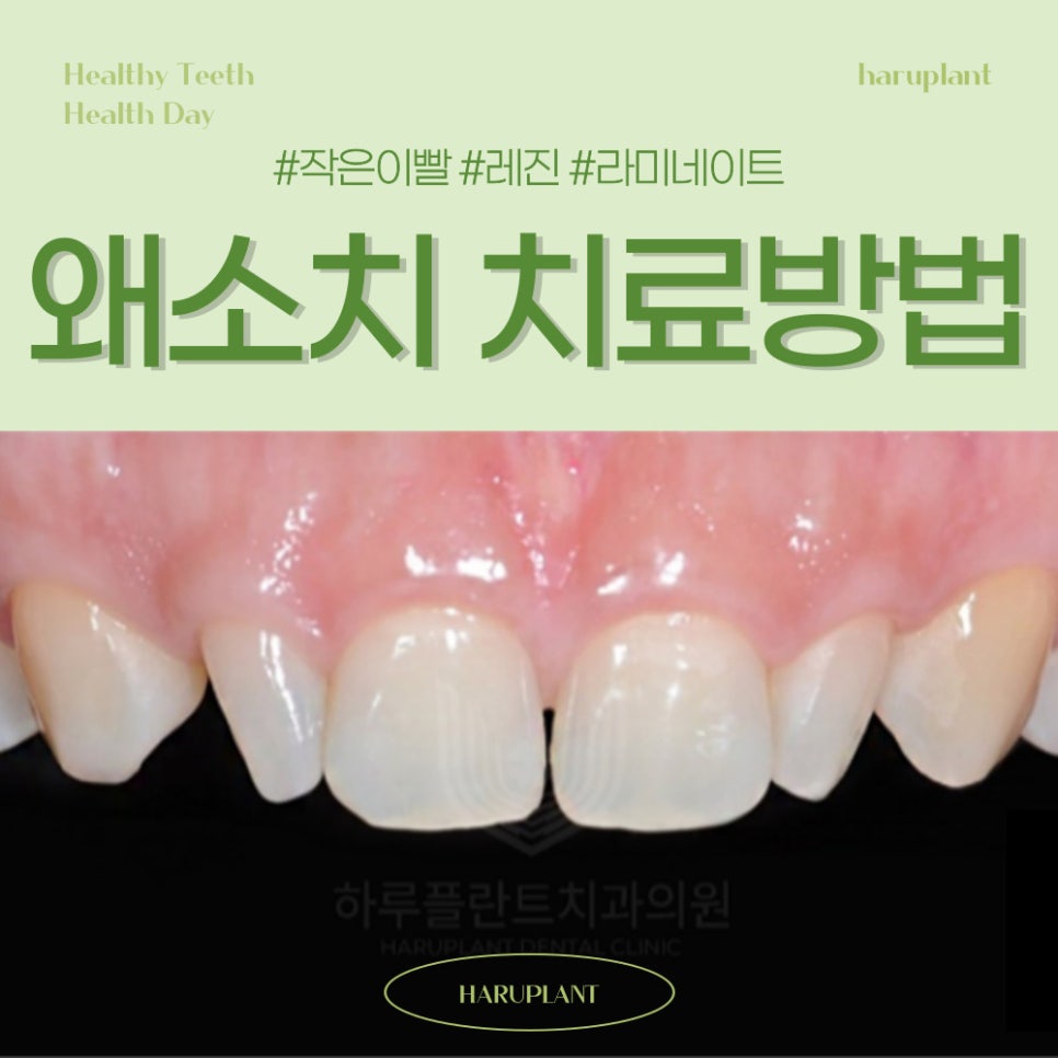 강남역 하루플란트치과 작은이빨 왜소치 치료방법은? 관련 이미지 1