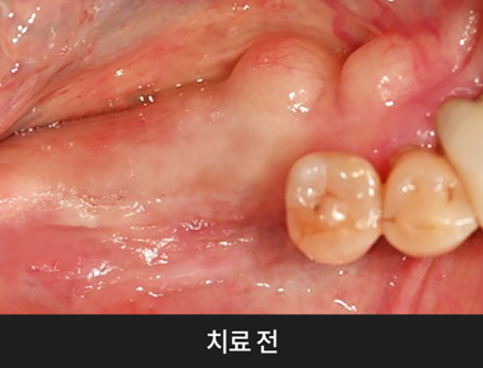 치과당일치료 하루플란트치과의 혁신적인 하루완성 클리닉 관련 이미지 2