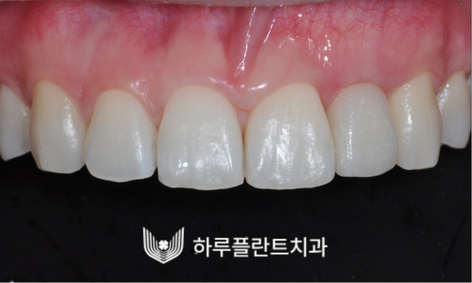 강남역 하루플란트치과 앞니 임플란트 후기 전후차이 관련 이미지 7