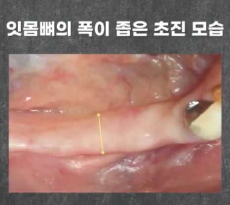 임플란트 전문가 변성만 원장 TV 출연 - 통증 줄인 무절개 임플란트 관련 이미지 4