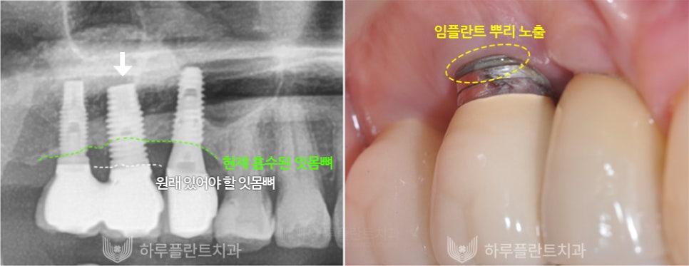 강남역치과 하루플란트치과 임플란트 주위염 원인부터 예방법까지 관련 이미지 3